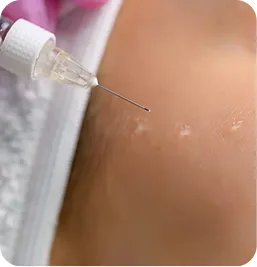 Tratamiento Bioestimuladores de Colágeno en Manos