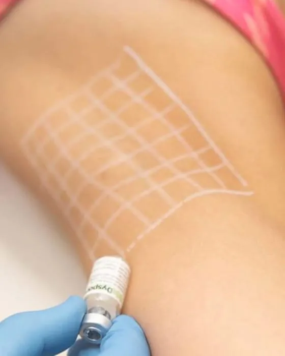 Tratamiento Toxina Botulínica – Botox® en Axilas