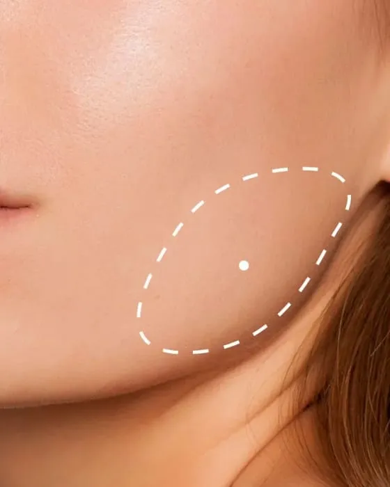 Tratamiento Toxina Botulínica – Botox® en Maseteros