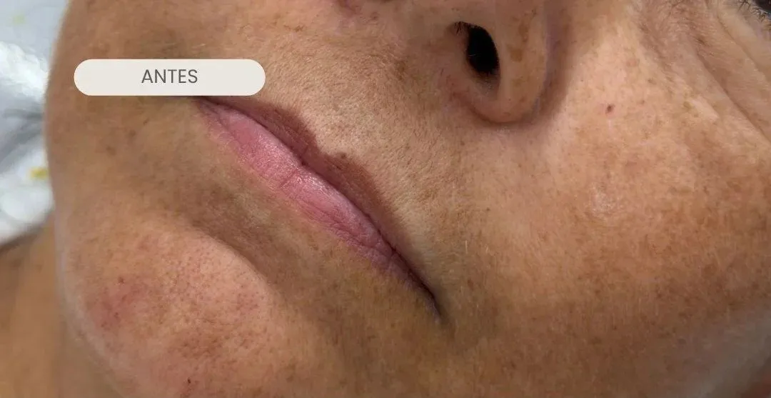 Labios y contorno de la boca antes del tratamiento