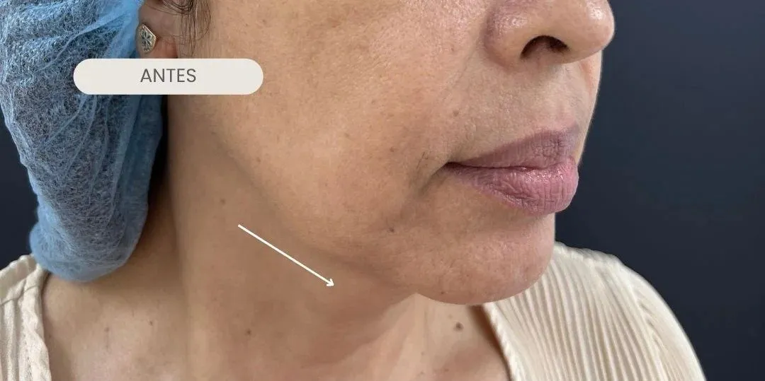 Mejilla y línea mandibular antes del tratamiento