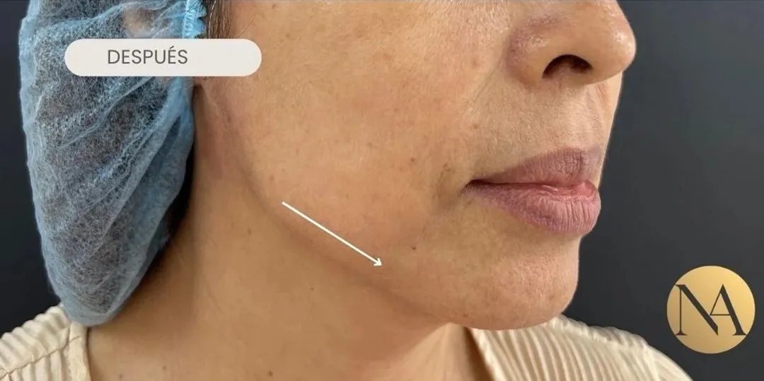 Mejilla y línea mandibular después del tratamiento