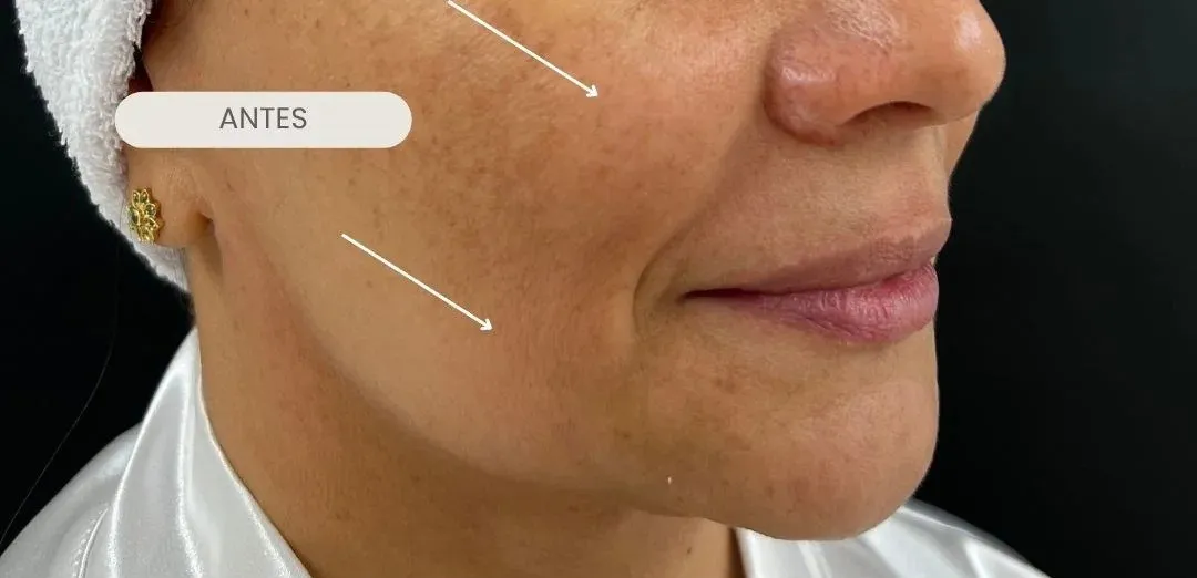Mejilla y contorno facial antes del tratamiento
