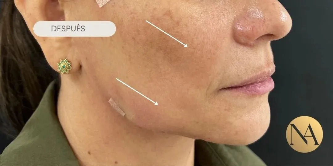 Mejilla y contorno facial después del tratamiento