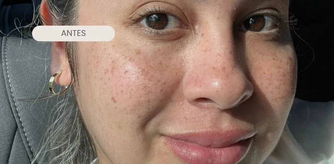 Piel del rostro antes del tratamiento