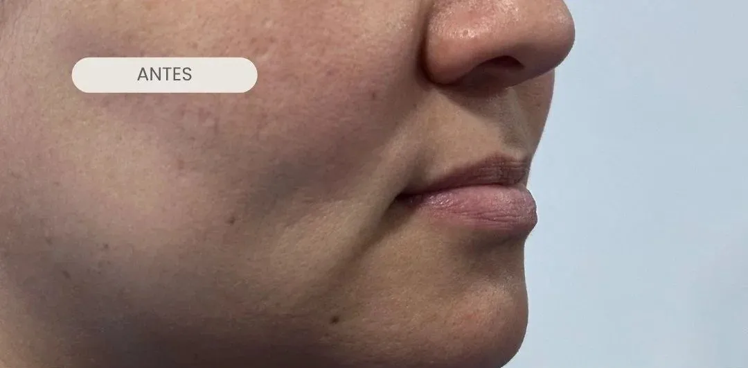 Labios de perfil antes del tratamiento