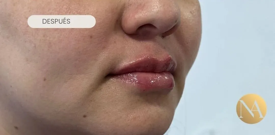 Labios de perfil después del tratamiento