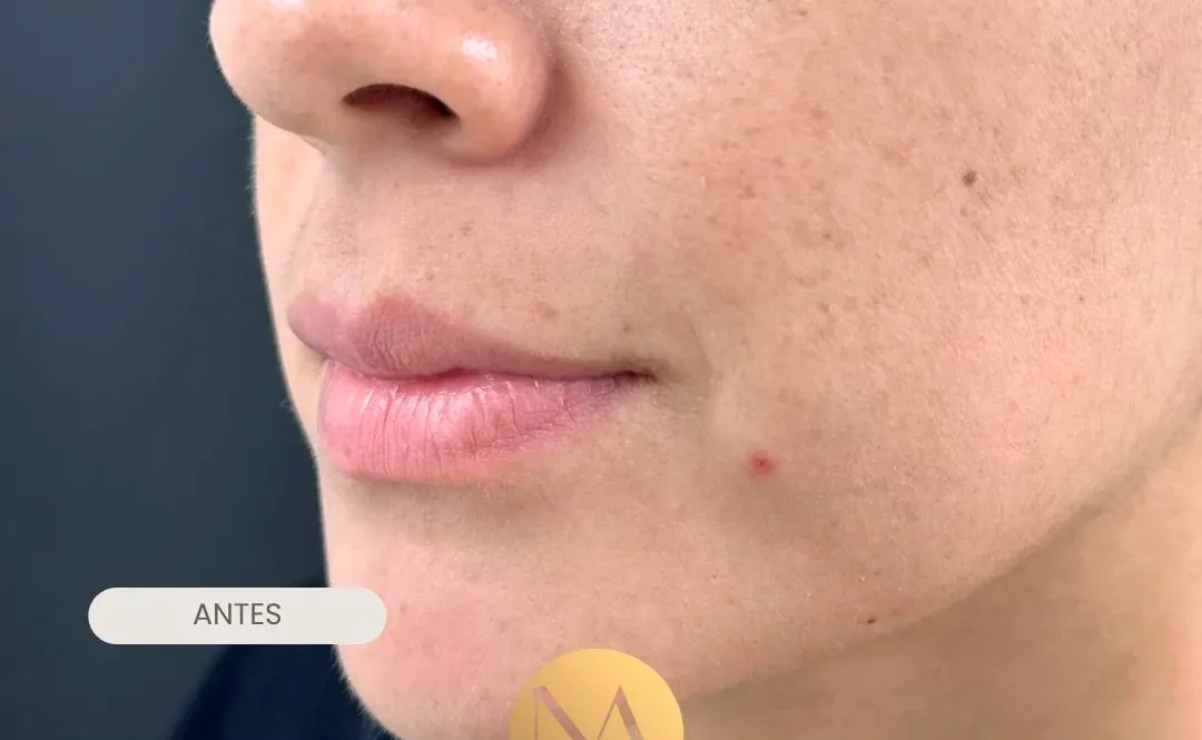 Labios de perfil antes del tratamiento