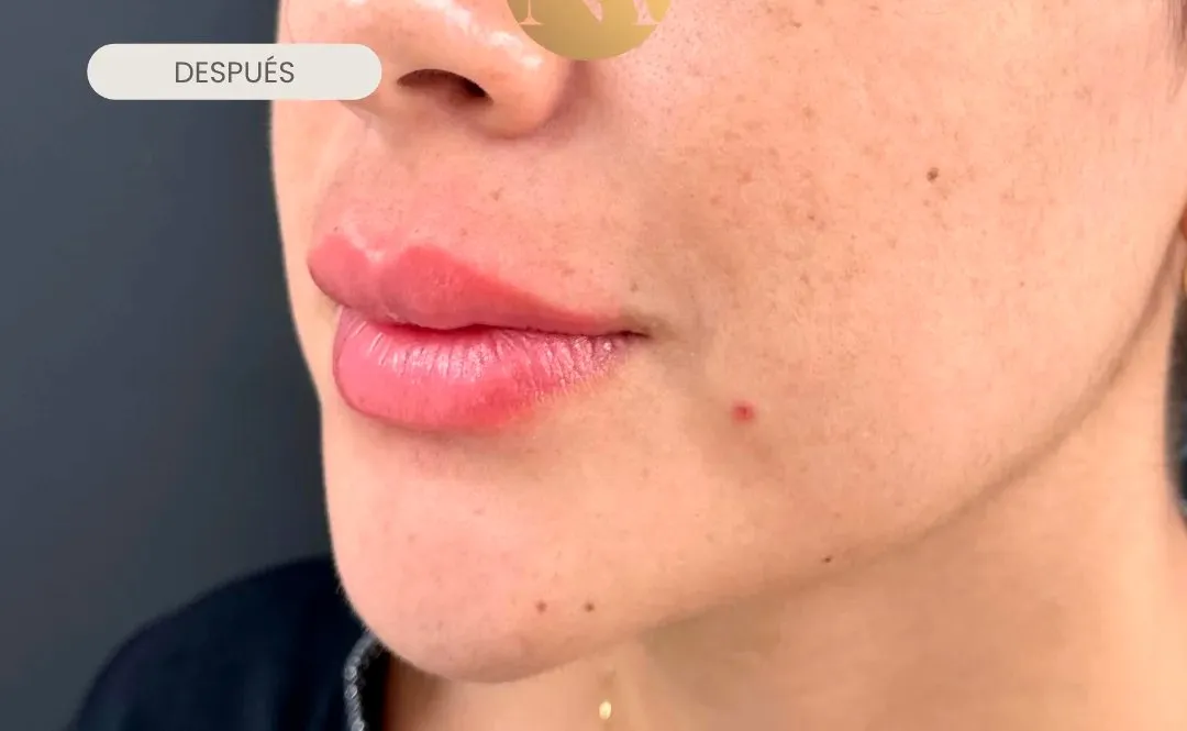 Labios de perfil después del tratamiento