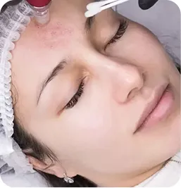 Tratamiento Peeling de Luminosidad