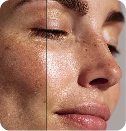 Tratamiento Peeling Químico – Meline