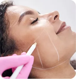 Tratamiento Sculptra® – Estimulación de Colágeno